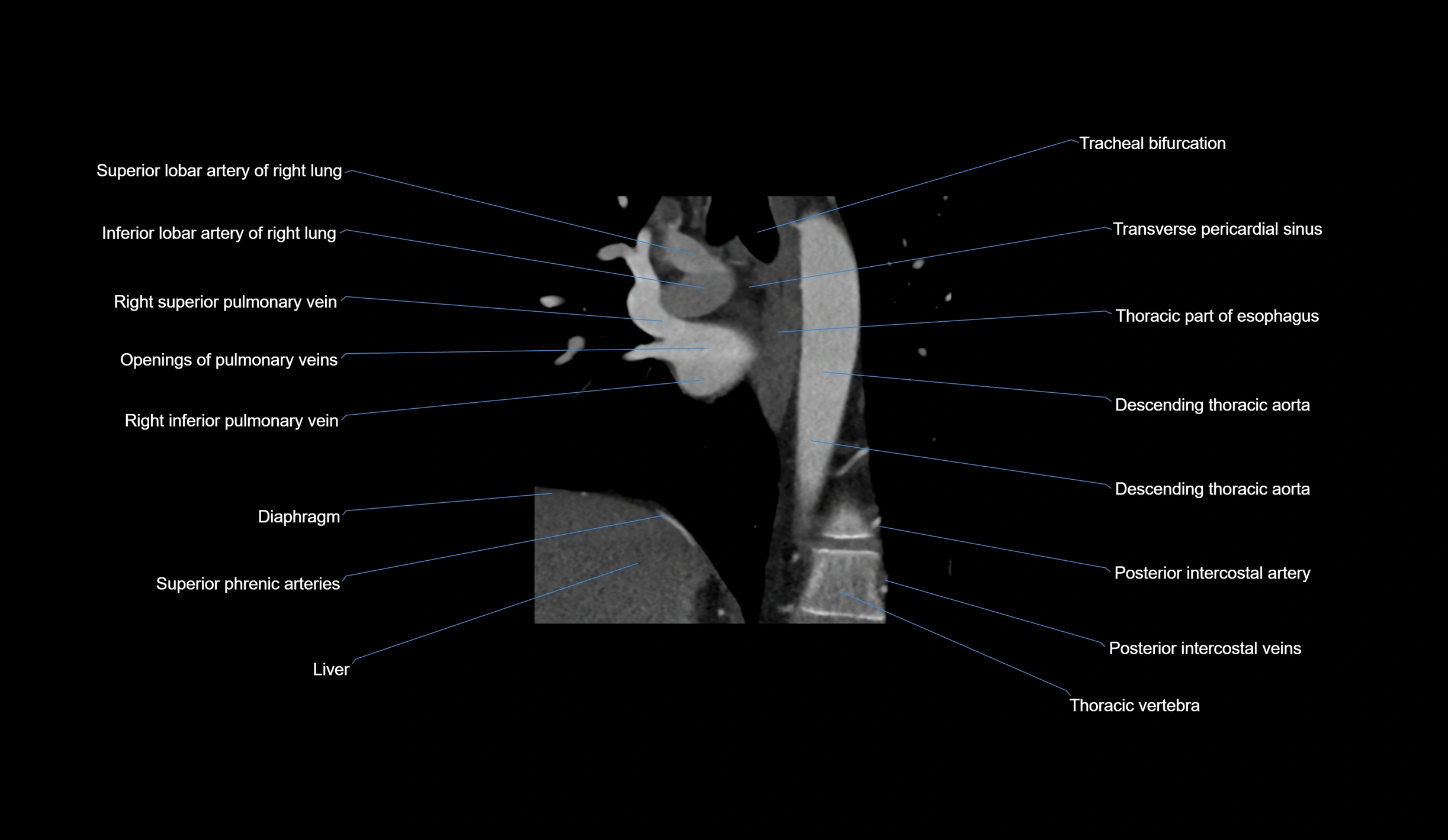 CT heart (coronary angiogram) short axis view  cross sectional anatomy labelled radiology image-00006.webp